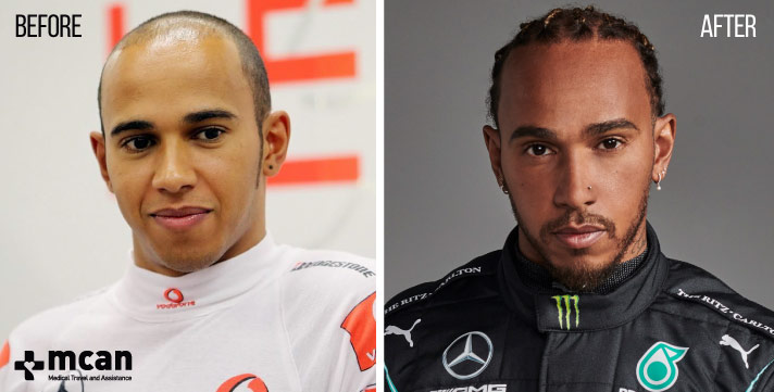 Lewis Hamilton Balding: Shocking Photos Spark Fan Debate