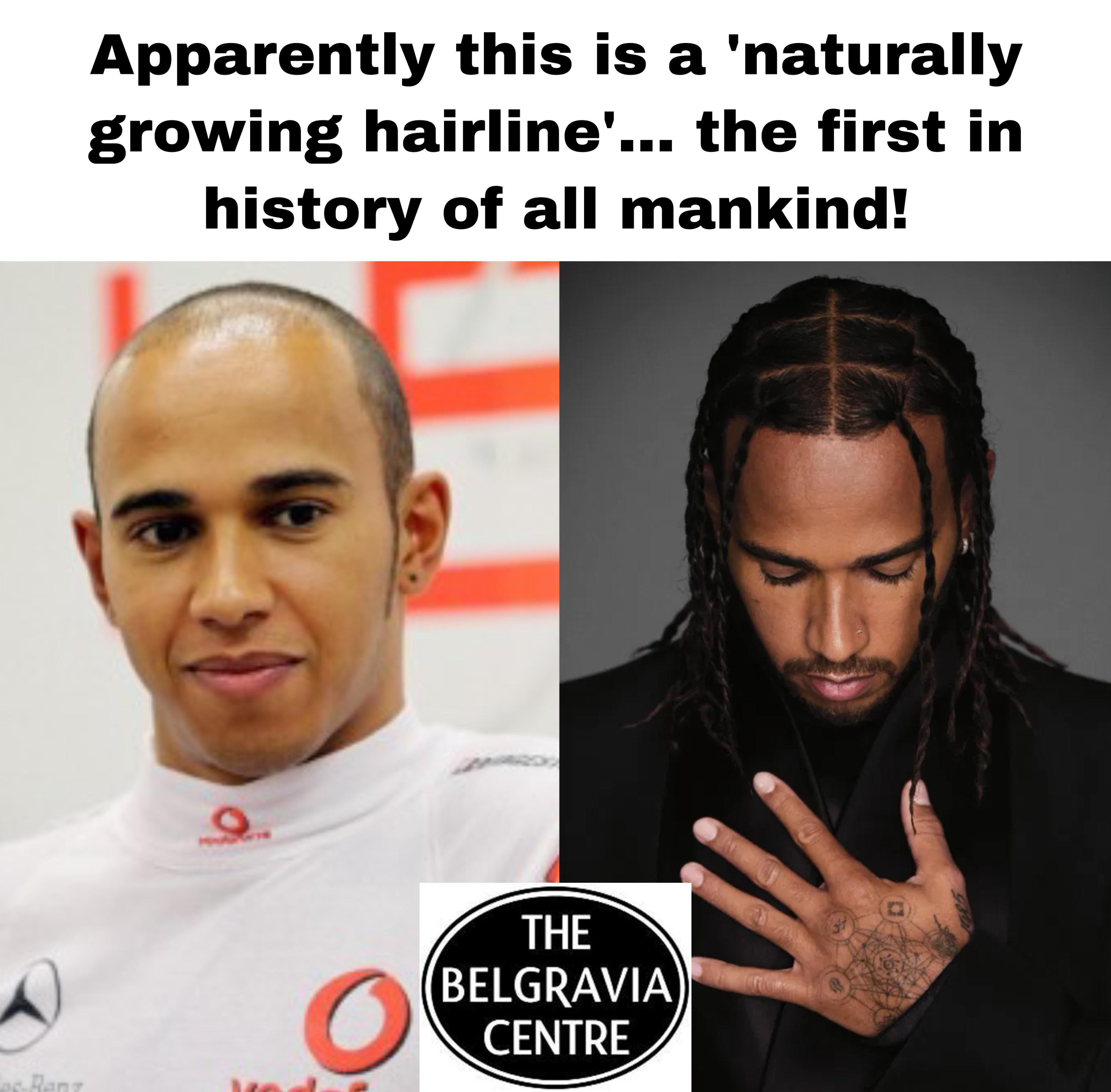Lewis Hamilton Balding: Shocking Photos Spark Fan Debate
